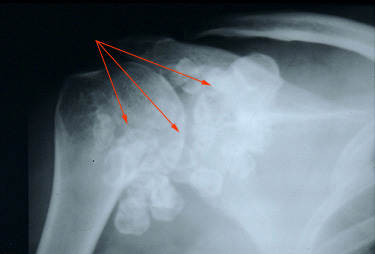 Glenohumeral Joint Space