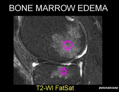 Bone Edema Mri