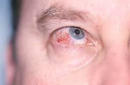 Episcleritis Nodular