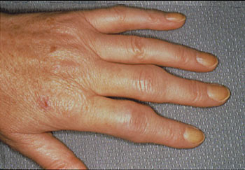 Swelling of the joints from Rheumatoid Arthritis