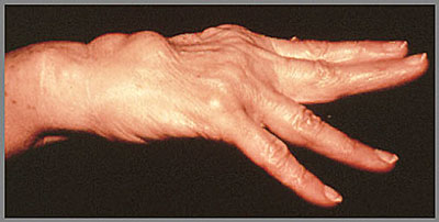 Deformity of the hand from Rheumatoid Arthritis
