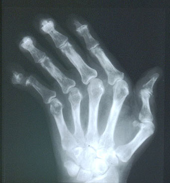 Radiology Rounds #6 - Arthritis Information