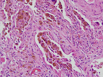 Round 3: Myopathy Presenting in the Context of Interstitial Lung ...